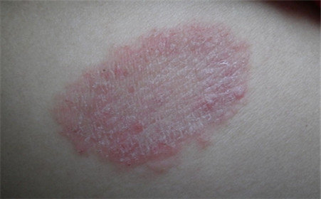 体癣 股癣的预防与治疗 - 好大夫在线