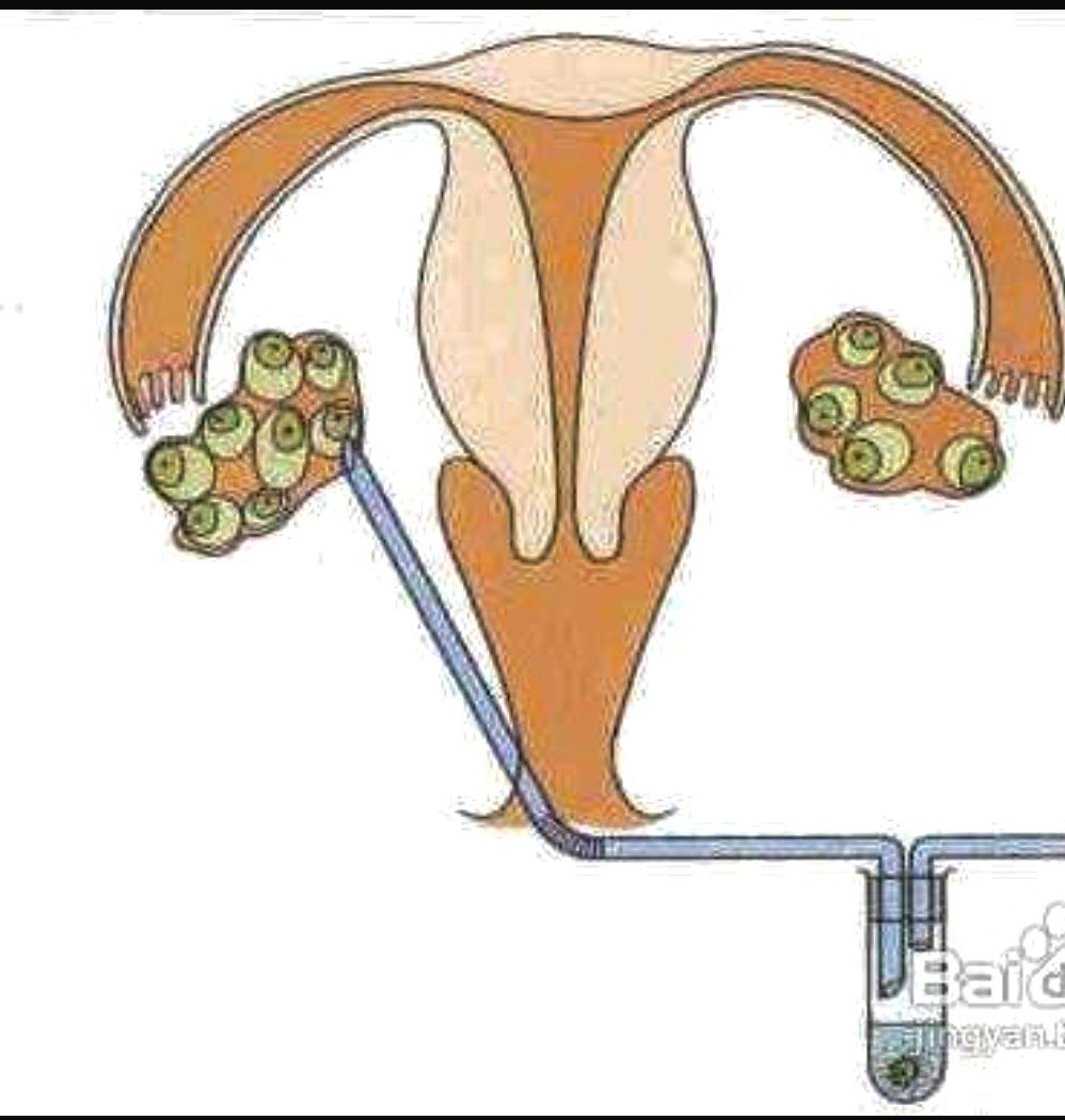 那些年不该治疗的盆腔积液