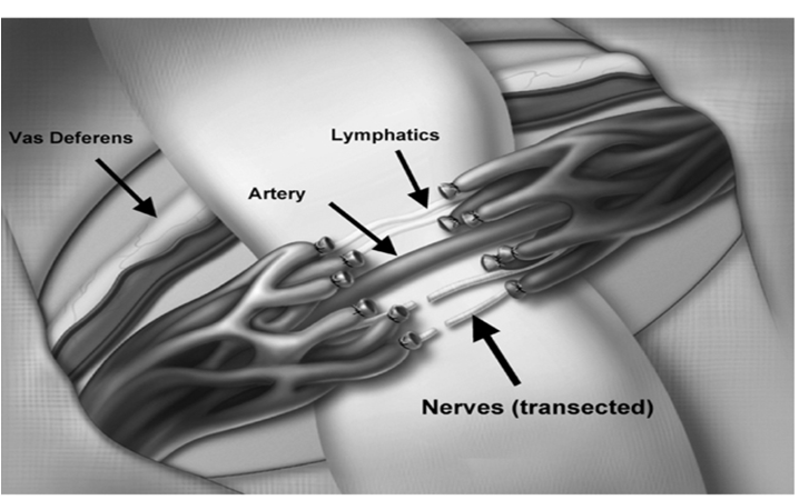 显微精索静脉结扎术---当代精索静脉曲张诊治