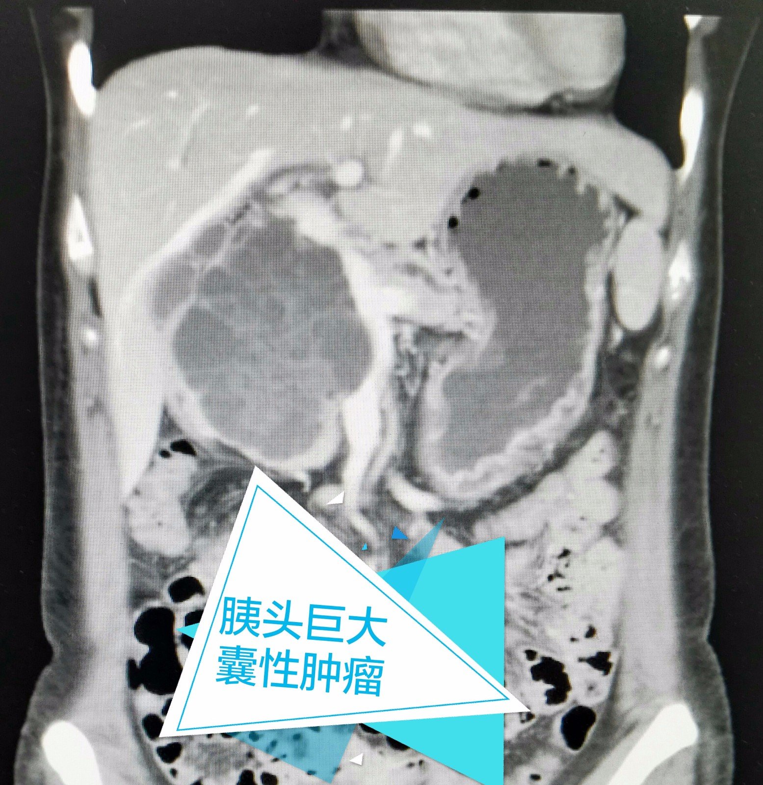 胰头巨大囊性肿瘤
