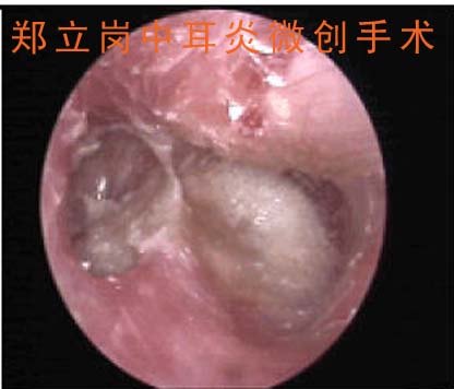 冯家樑耳内镜1.jpg