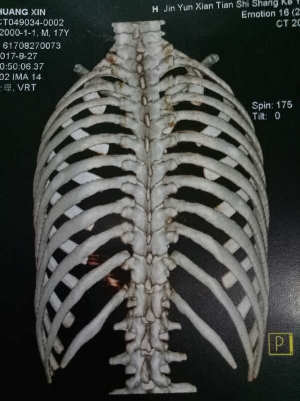 胸椎小关节错位功能紊乱导致肋软骨炎 (原创)