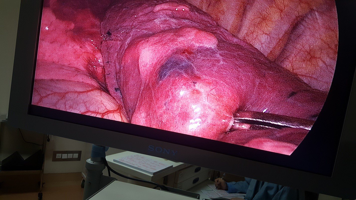 术前精确定位技术联合微创手术成功解决肺小结