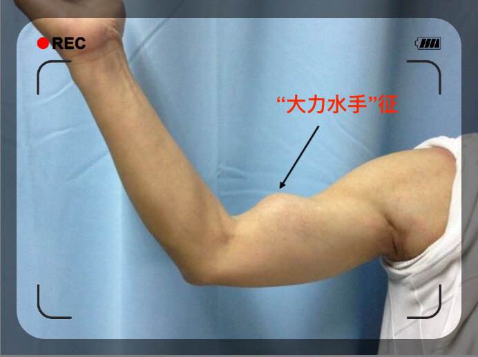 lump",是指当肱二头肌肌腱发生断裂时,断裂处远端肌腹收缩下移,在上臂