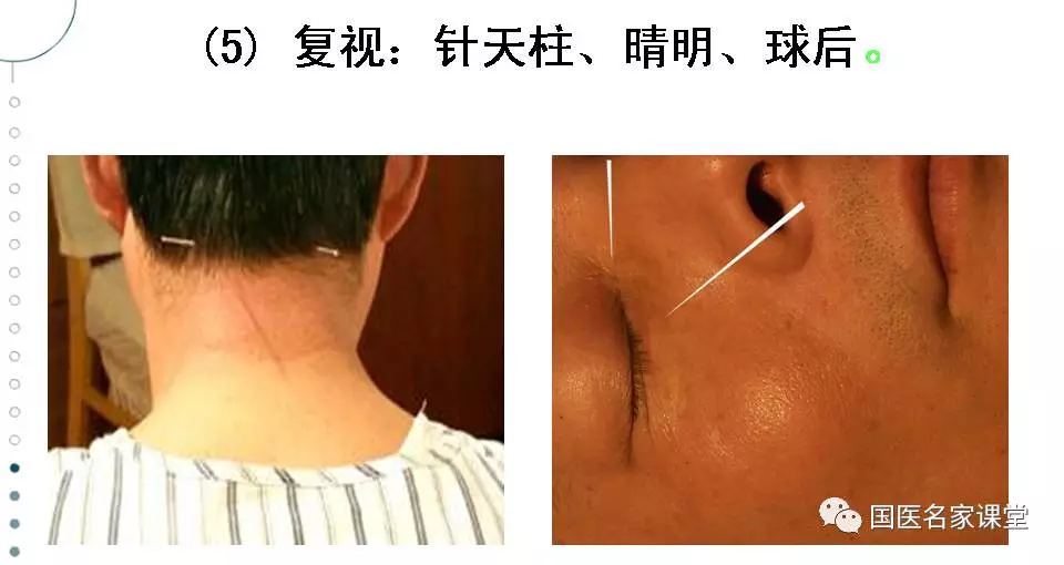 石学敏醒脑开窍针刺法