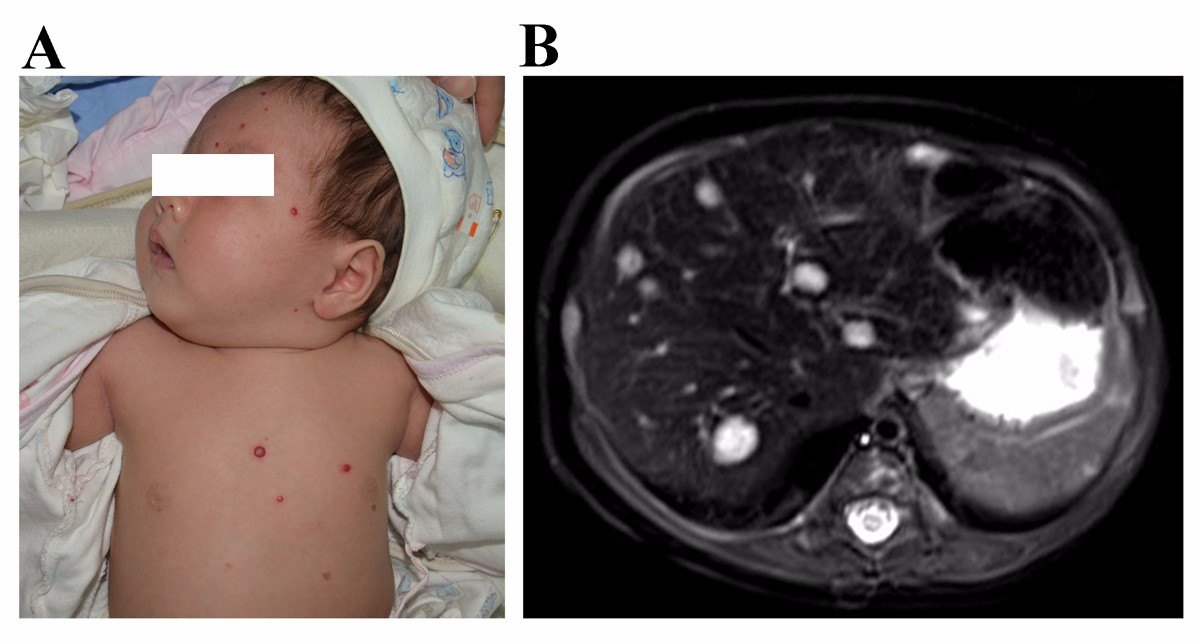 婴幼儿肝血管瘤的临床特点与危害