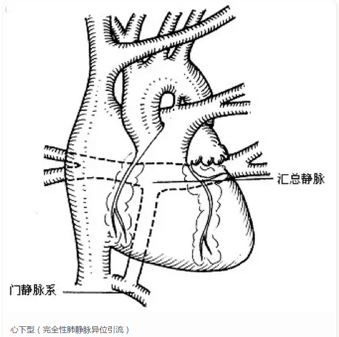 根据肺静脉引流的位置,完全性肺静脉异位引流分为四种类型:心上型,心