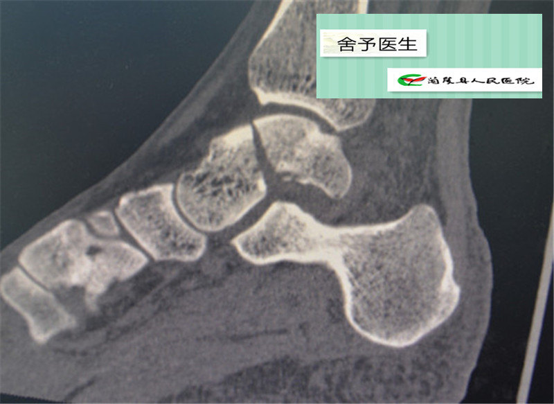 距骨骨折术后一年复查