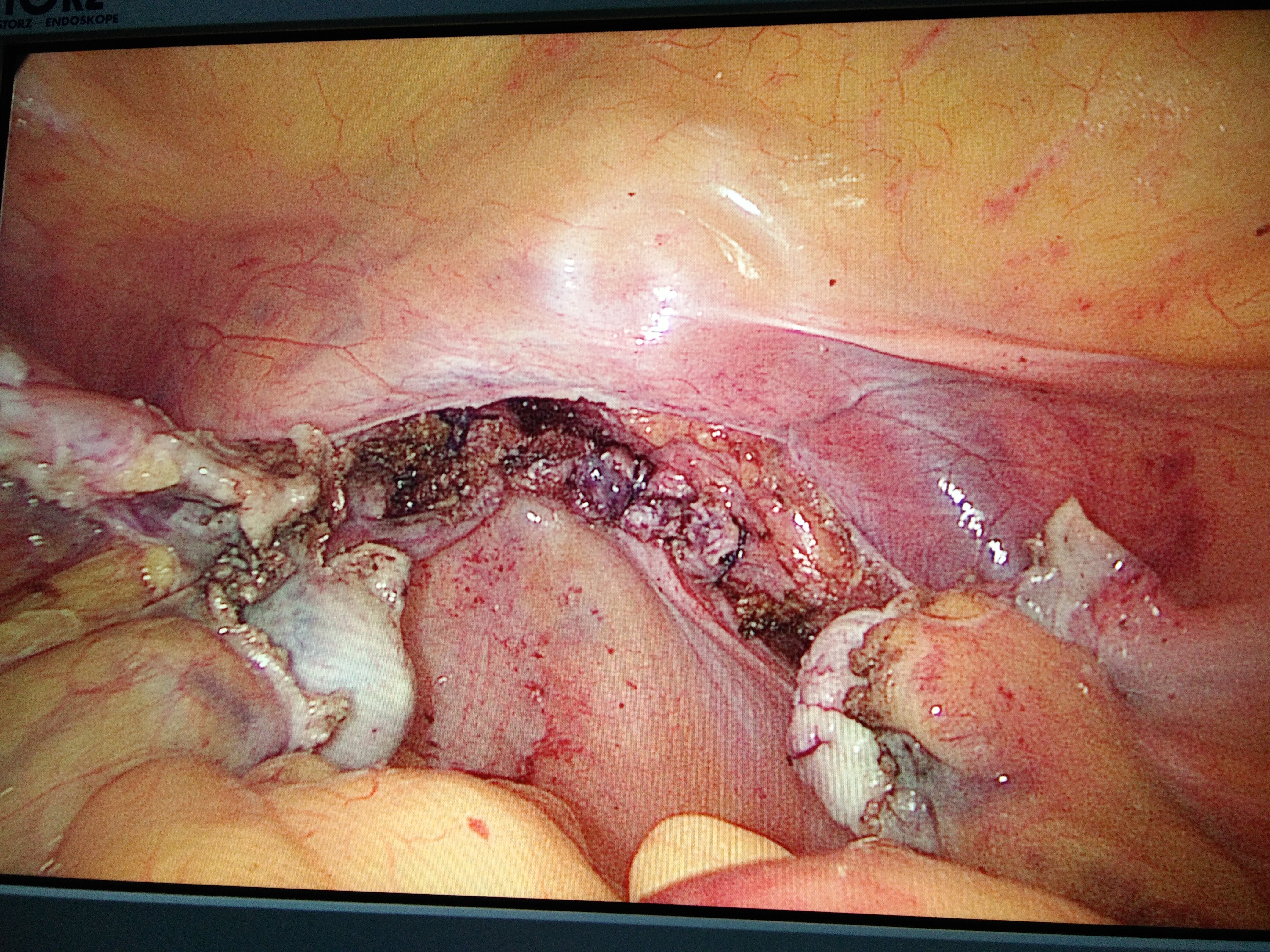腹腔镜下全子宫切除术后的图片