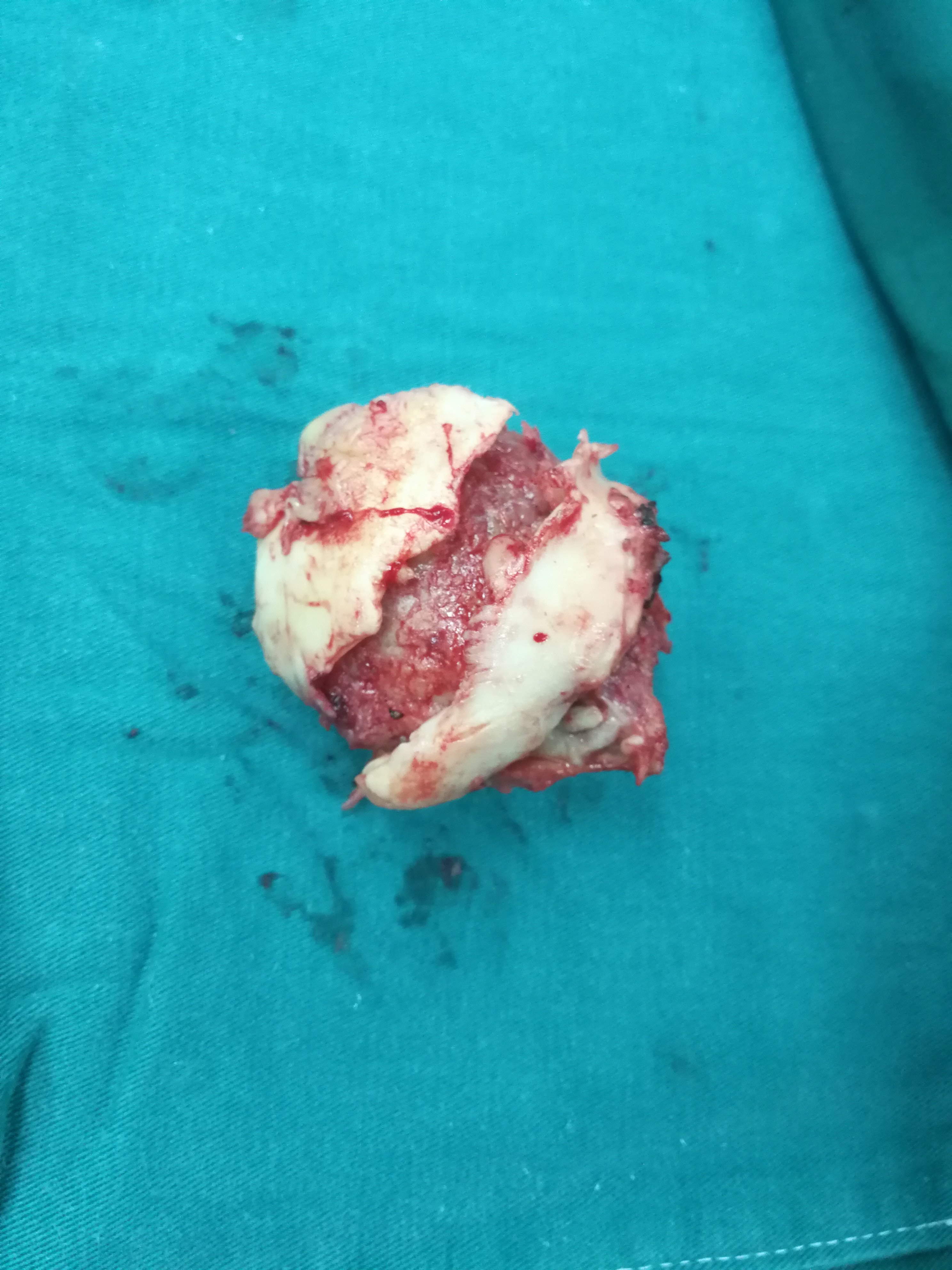 股骨头坏死片子不严重你会想到实际取下股骨头变这样吗