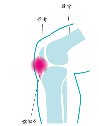 女性膝骨性关节炎与半月板损伤和软骨下骨髓水肿（BME）的相关性研究