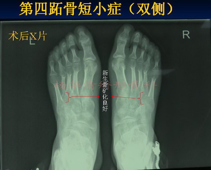 第四跖骨短小症双足典型病例