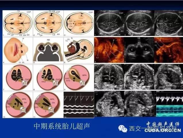 四腔心切面,左心室流出道切面,右心室流出道切面,对可疑胎儿