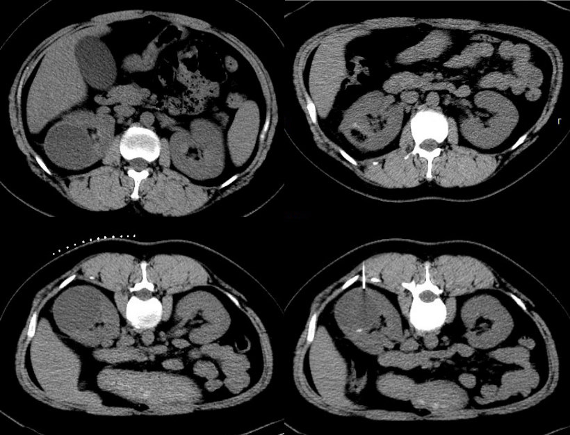 肾脓肿ct引导下经皮穿刺抽吸治疗