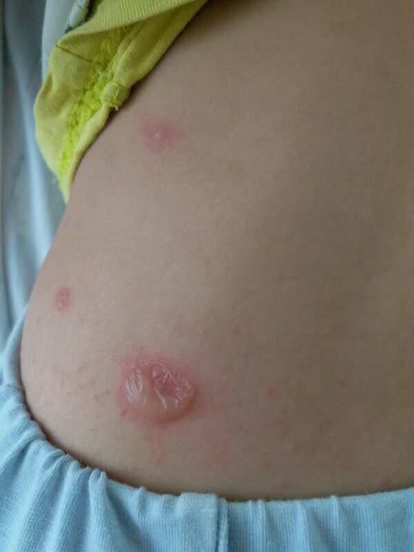 儿童脓疱疮:急性 接触性 传染性 皮肤病,通常由金黄色葡萄球菌引起