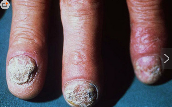 指甲里的秘密:指甲异常与全身性疾病 作者:rain