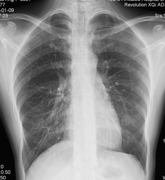 胸片能筛查早期肺癌吗?