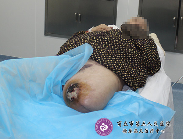 糖尿病脚上的伤口时间长了开始变黑是要感染吗