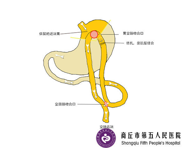 <!--HAODF:8:feipangzheng-->肥胖症<!--HAODF:/8:feipangzheng-->病人的高血压高血糖能治好吗