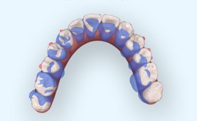 为何矫正牙齿经常需要拔牙呢? --2017 Update