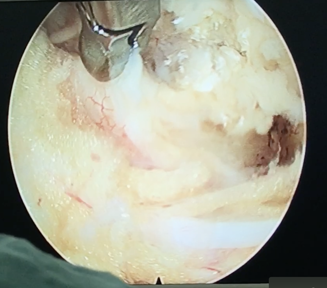 腰椎管狭窄的微创内镜手术:DELTA 大通道椎板