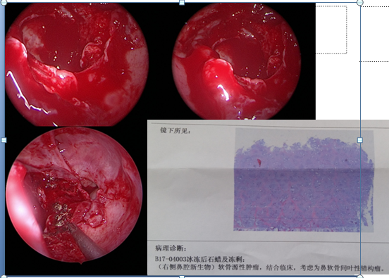 术中情况和病理报告.png