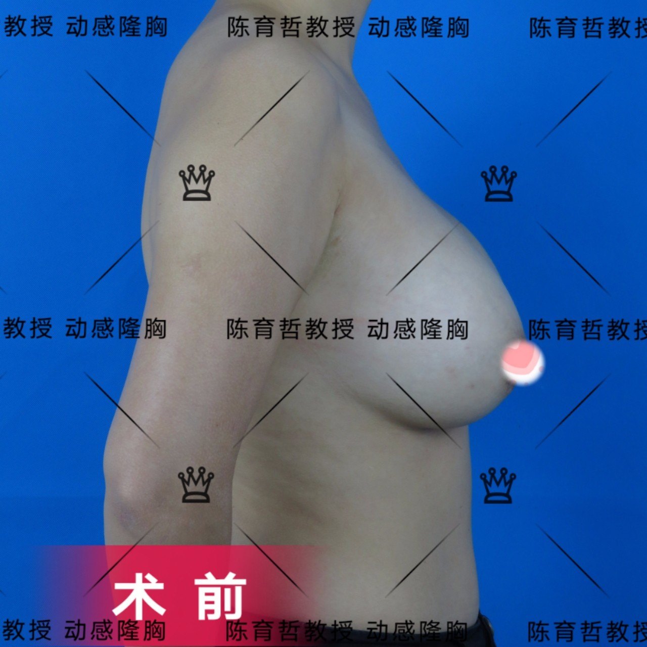 动感隆胸案例(36)注射物取出再植入假体的包膜