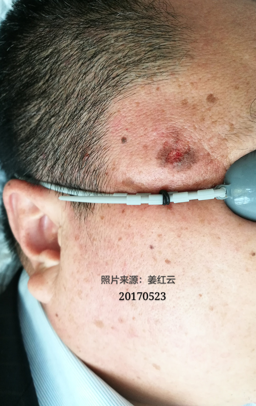 老年斑上又长了老年疣,该如何治疗呢?