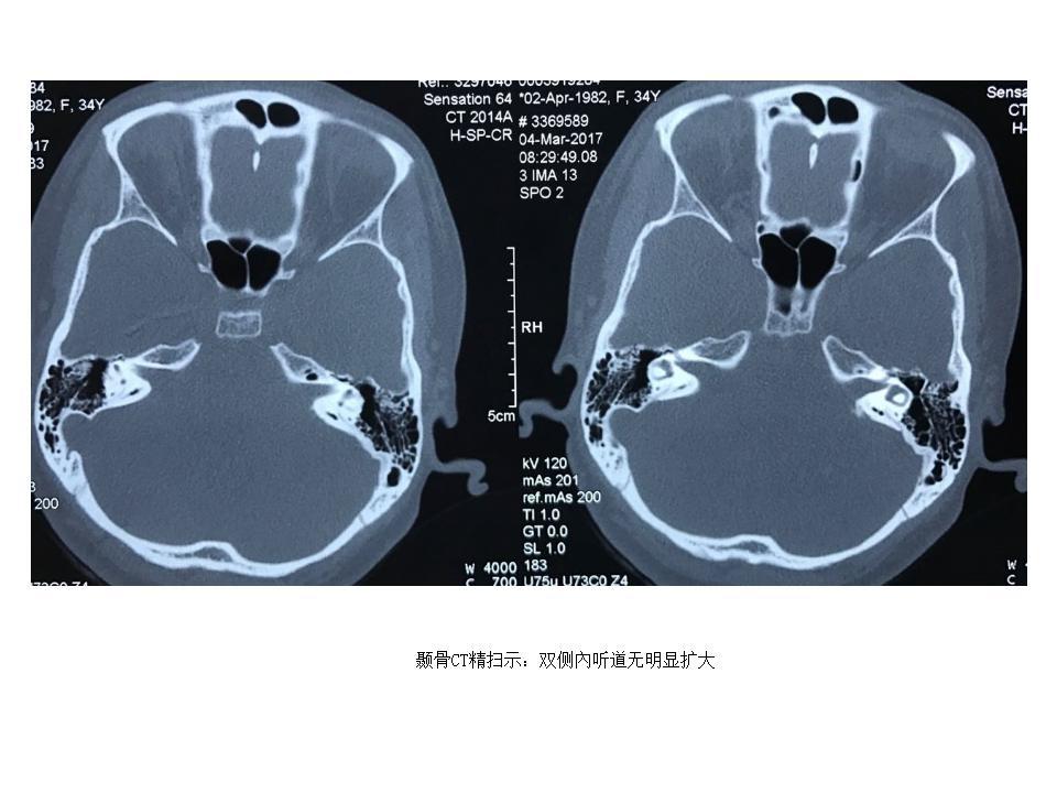 微创手术切除颅底(桥小脑角区)巨大脑膜瘤
