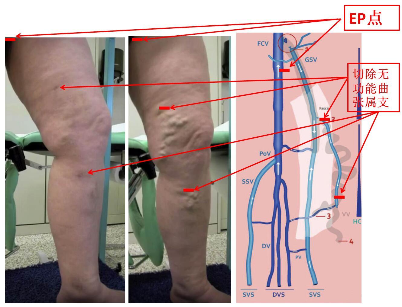 下肢静脉曲张的极致微创手术保留大隐静脉的chiva术