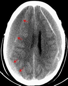慢性硬膜下血肿患者须知 - 好大夫在线