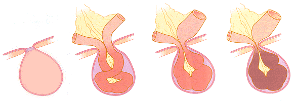 stragulated hernia.png