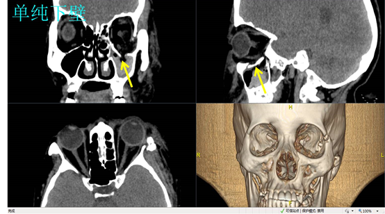 眼眶骨折的ct表现