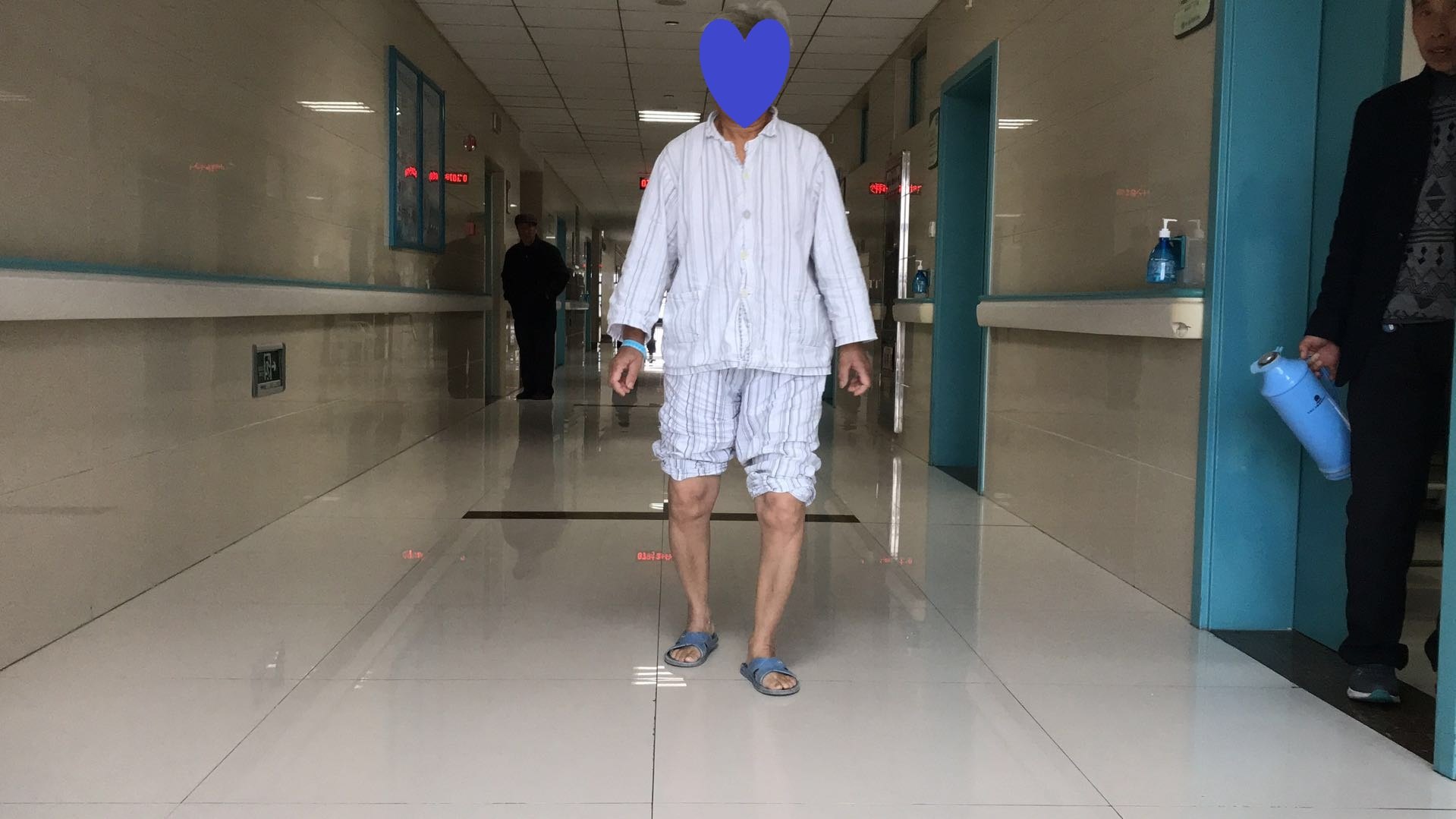 沛县人工膝关节置换患者评价徐州二院骨科高绪