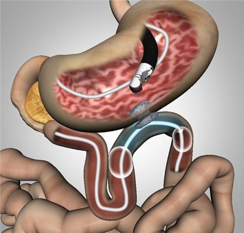 1513498069636770.jpg 超声胃镜3.jpg