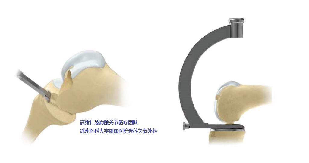 图解oxford牛津单髁膝关节置换手术过程18步