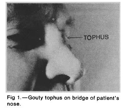 你所不知道的痛风之七:鼻梁上的痛风石_好大夫