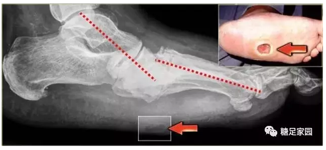 糖尿病足-认识夏科氏足病 - 好大夫在线