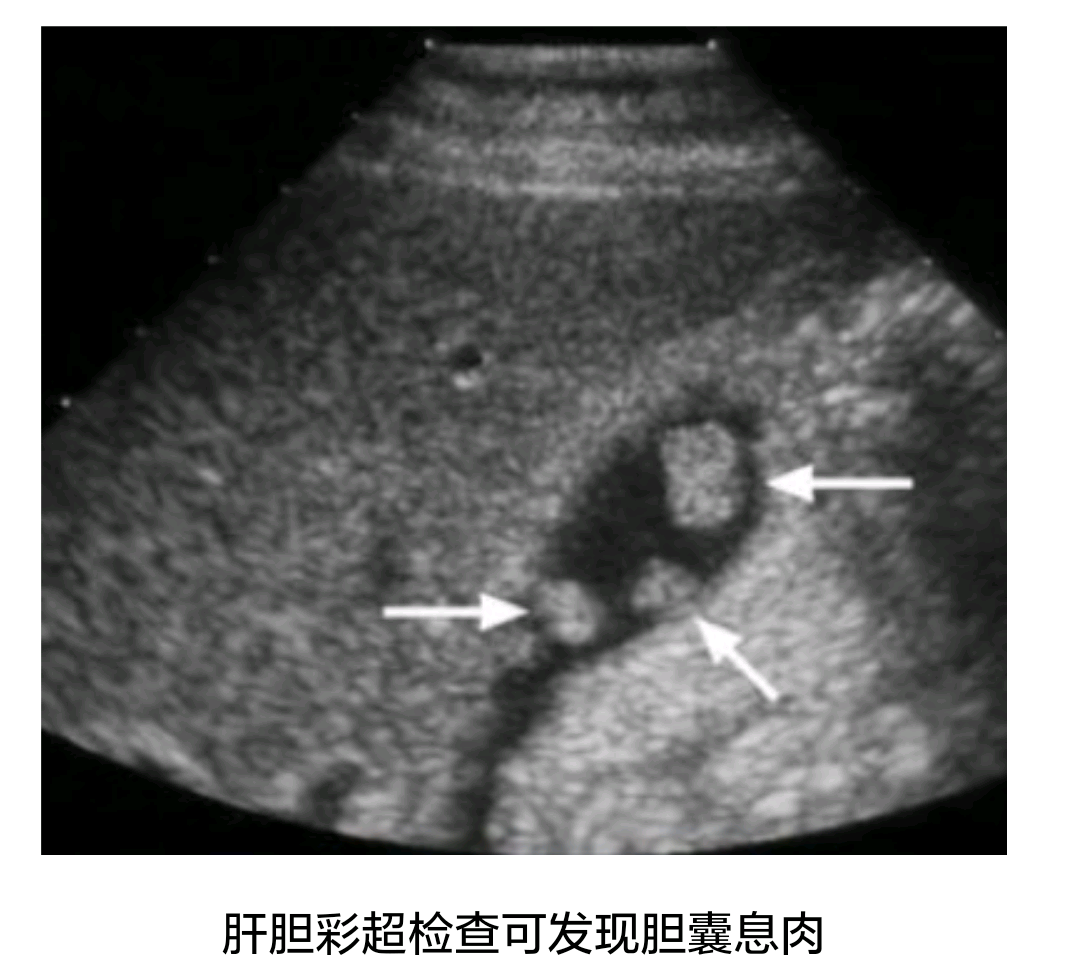 很多40岁以上的中老年叔叔阿姨   在体检的时候肝胆彩超经常会报胆囊