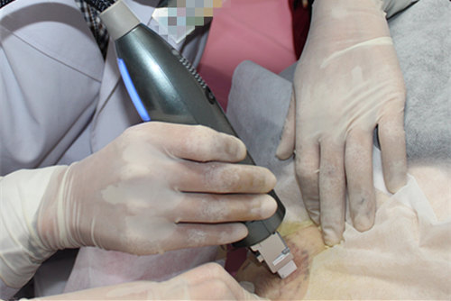 臭\/腋下多汗的治疗方法及最新进展(黄金微针治