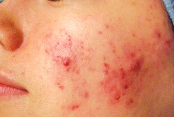 Type-2-3-Acne-on-Face.jpg