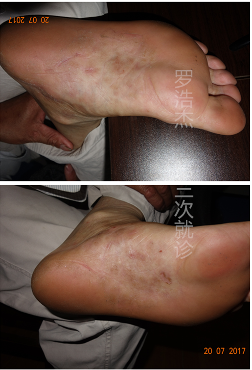 足底长期慢性湿疹肥厚型治愈案例