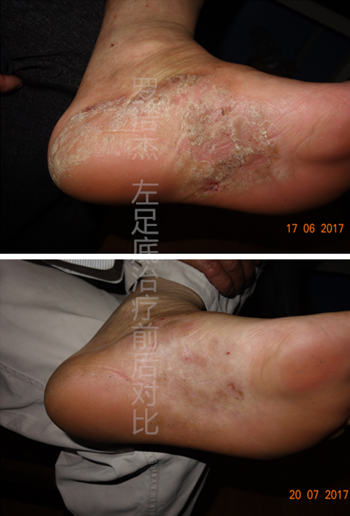 足底长期慢性湿疹(肥厚型)治愈案例