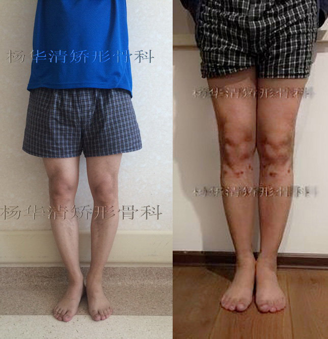 o型腿手术矫治膝内翻病例