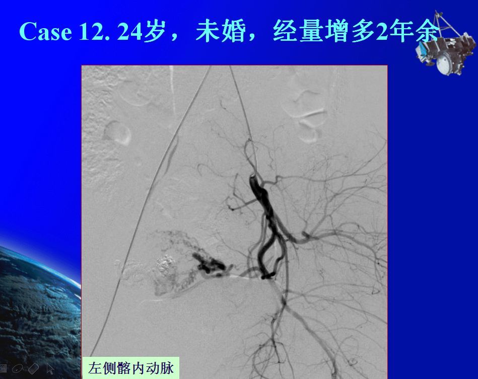 对侧髂内动脉造影显示畸形血管团彻底栓塞后左侧子宫动脉分支再也无法
