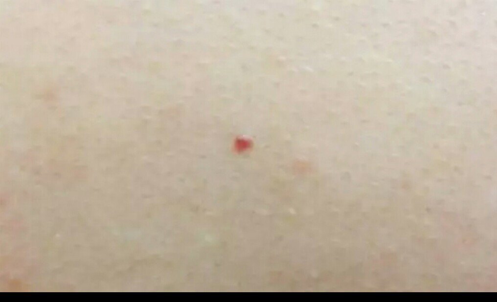 皮肤上的小红点是什么?会癌变吗? (转载)