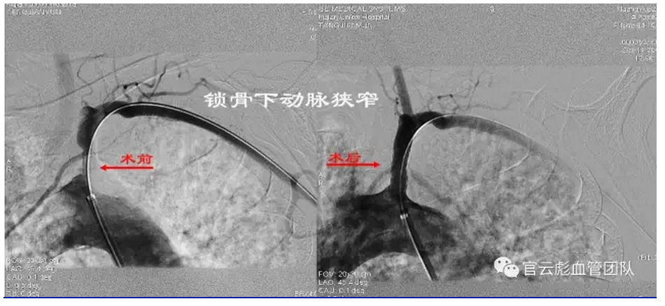 官云彪 官云彪血管外科团队诊疗的常见血管疾病锁骨下动脉盗血综合