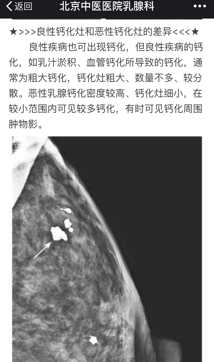 乳腺钙化灶是什么东东