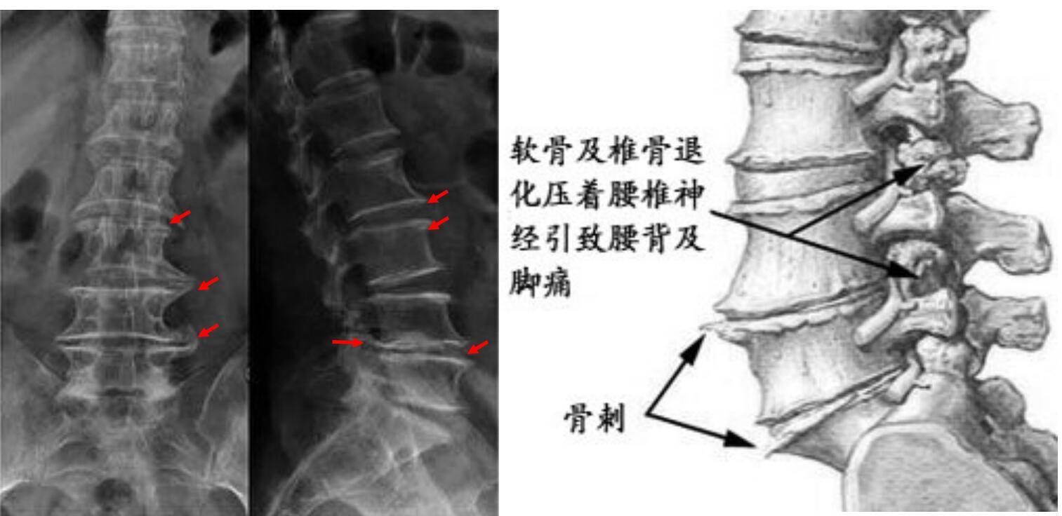 图5 腰椎<!--HAODF:8:guzhizengsheng-->骨质增生<!--HAODF:/8:guzhizengsheng-->X片.jpg