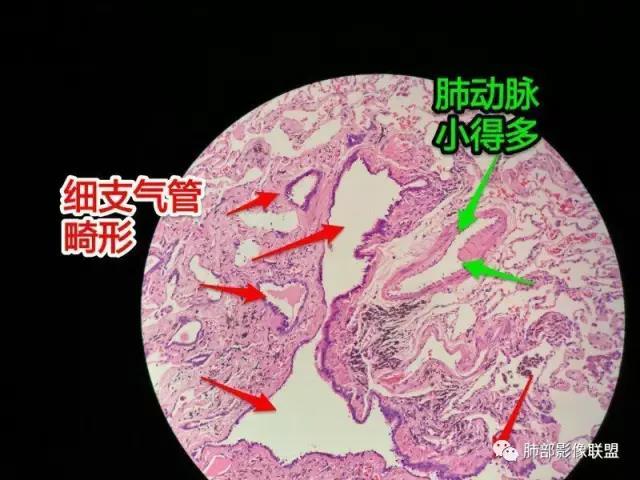 5x1x1cm,紧临被膜 这例来自邢台人民医院齐蕾老师,也考虑是终末支气管